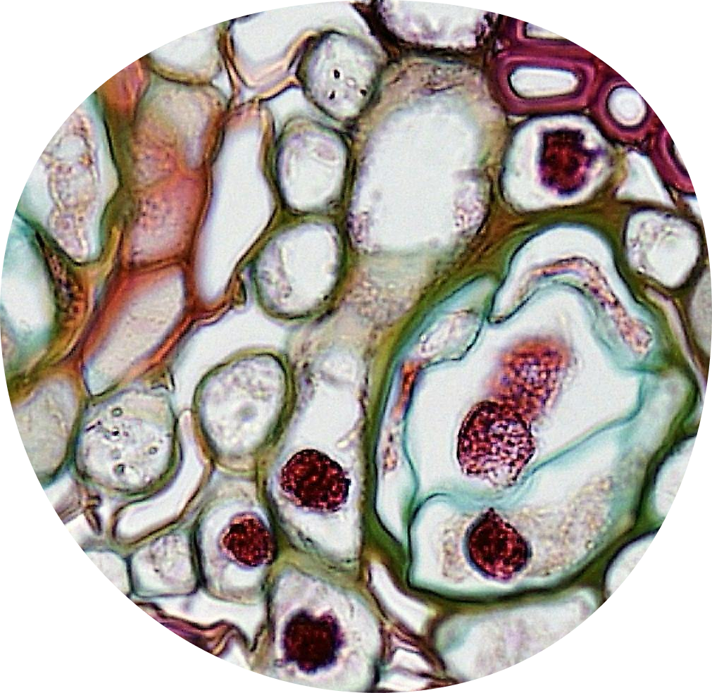 Endometriosis